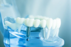 teeth and bridges - dental care
