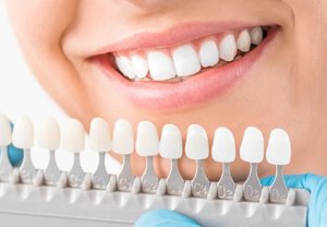 Matching teeth color is part of the process of getting dental implants