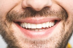 Man smiles after a successful teeth bonding treatment